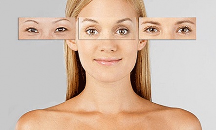 Блефаропластика